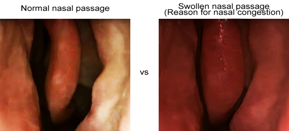 Normal vs Swollen nasal passage